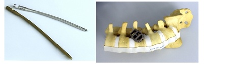 Das Pedikelschraubensystem VIPER 3D-MIS-Korrektur-Set für chirurgische...