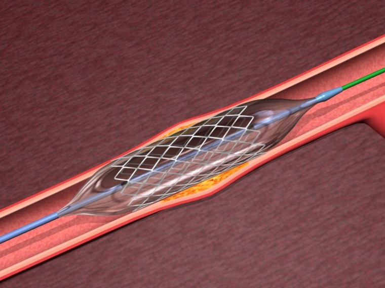 Mit Hilfe von biochemischen Veredelungsmethoden wurden Implantate in den...